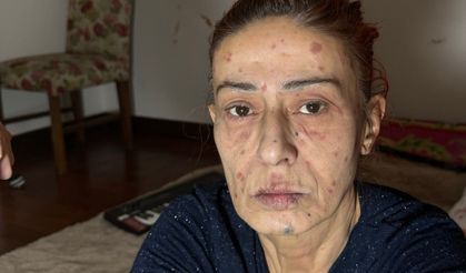 Ünlü sanatçının yüzü yandı!